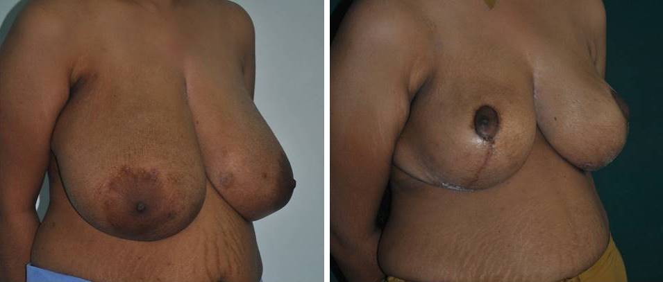 Reduction mammaplasty in Kerala, India